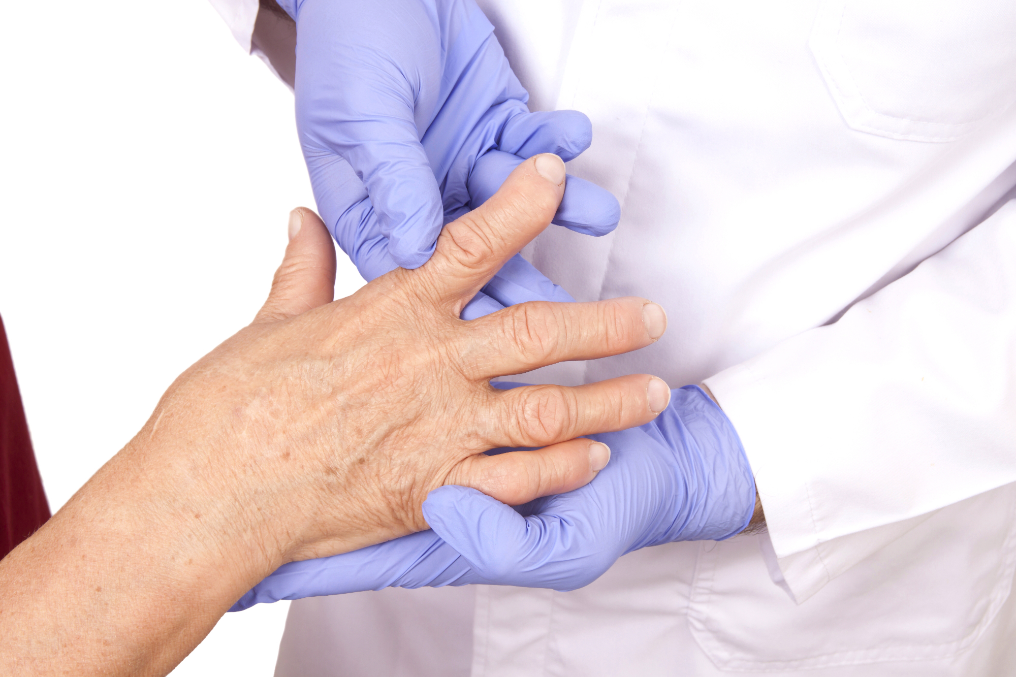 Na revmatoidni artritis lahko vpliva predvsem dednost in spol